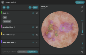 idea® Software: strukturierte Hautanalyse nach Farbe, Muster und Form